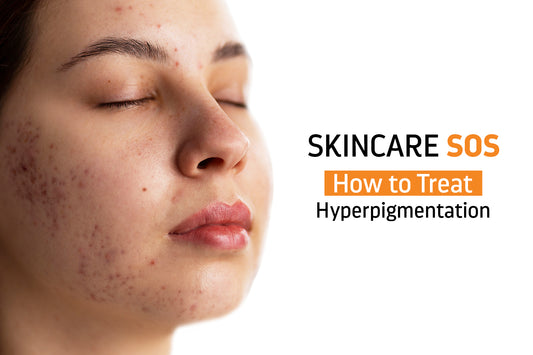 Skincare SOS: How to Treat Hyperpigmentation for Melanin-Rich Skin