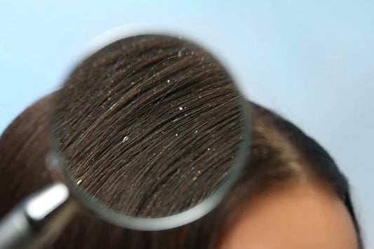 The dreaded d-word-dandruff