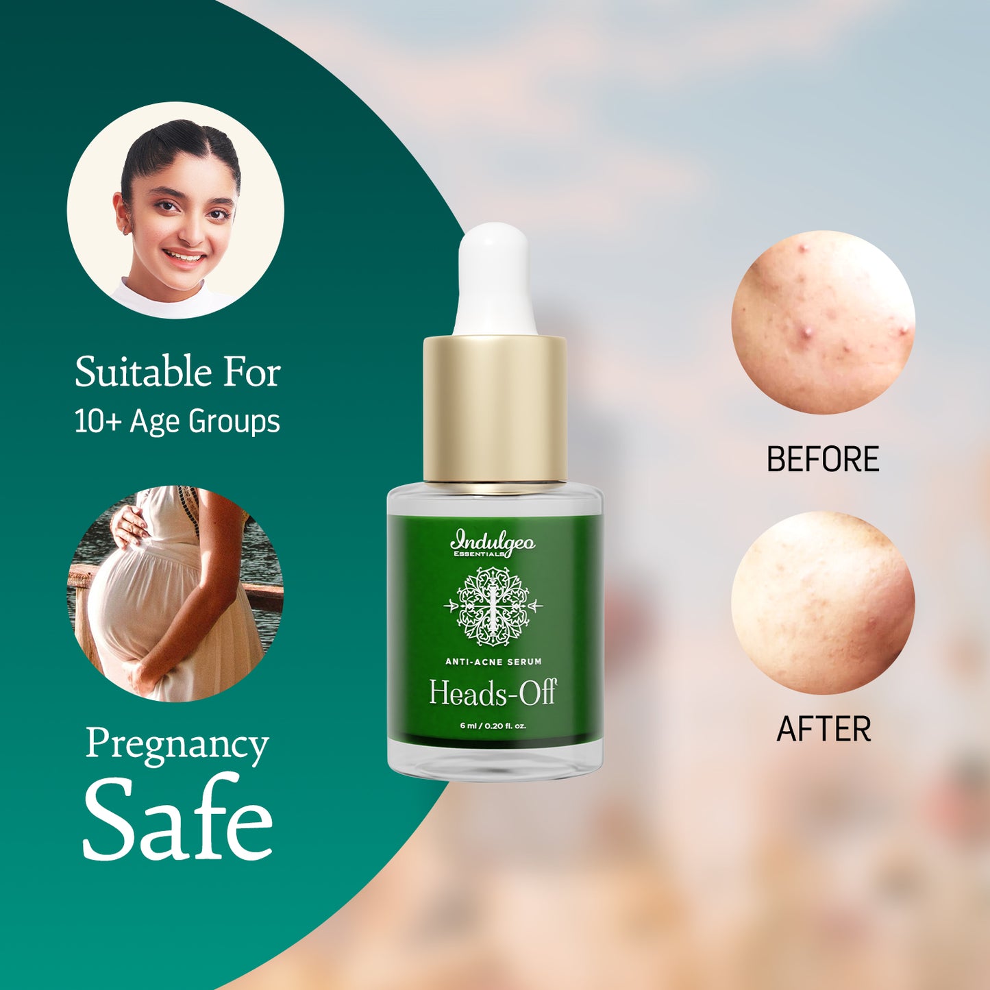 Heads Off - Anti Acne Serum For Blackheads & Whiteheads