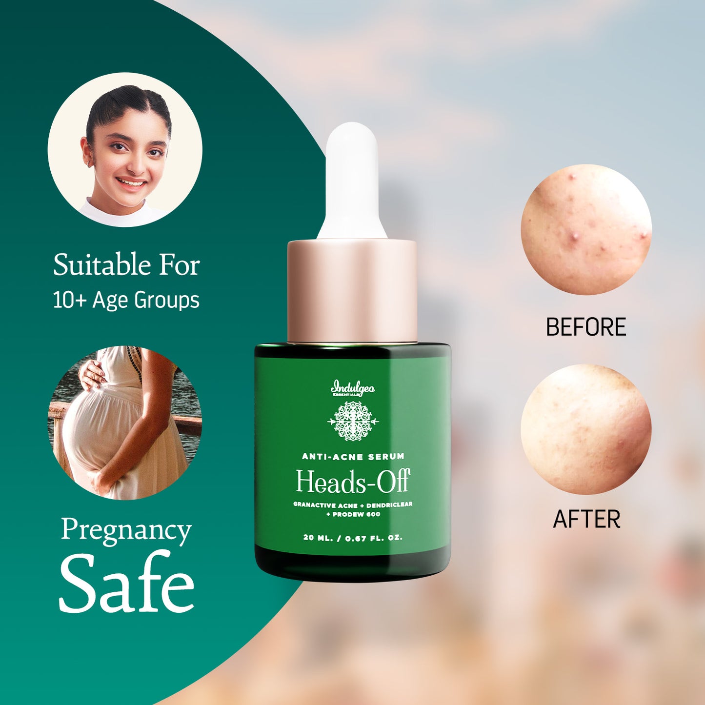 Heads Off - Anti Acne Serum For Blackheads & Whiteheads