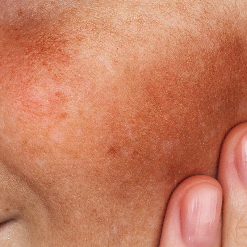 Dark Spots & Pigmentation