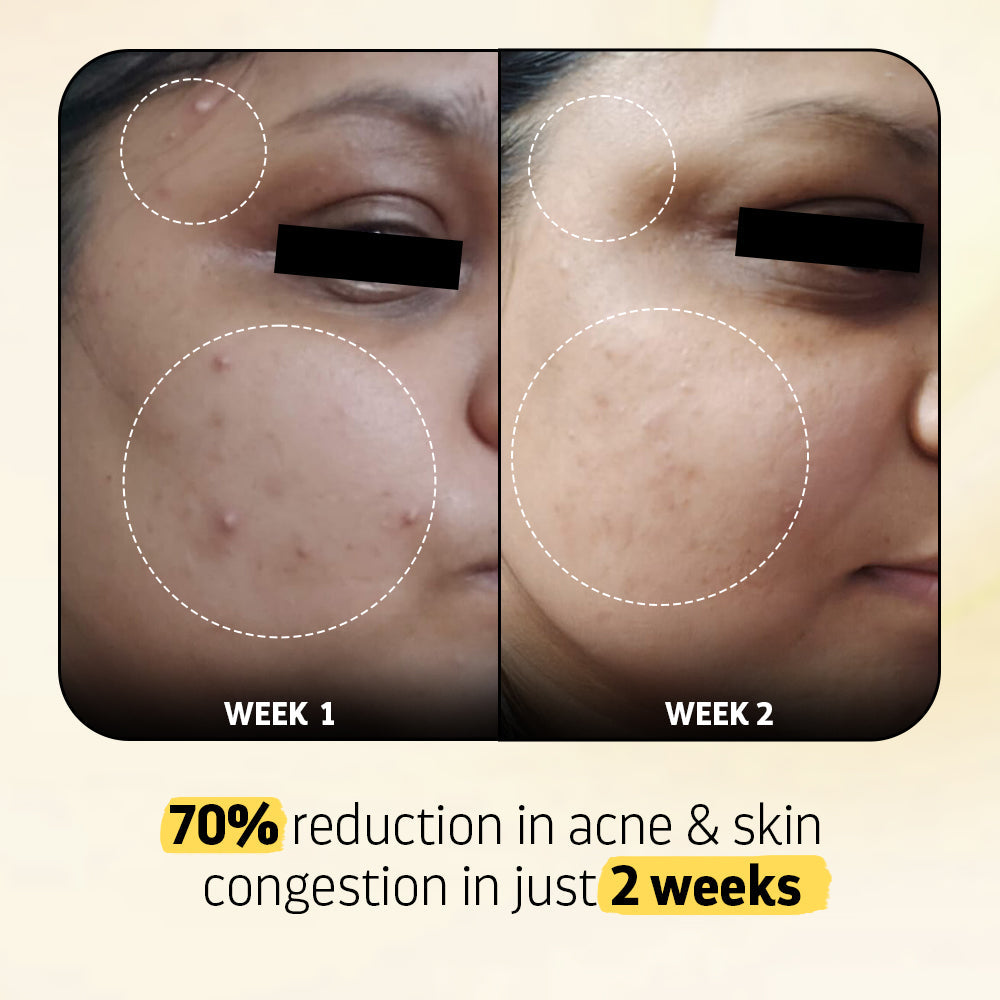 Heads Off - Anti Acne Serum For Blackheads & Whiteheads