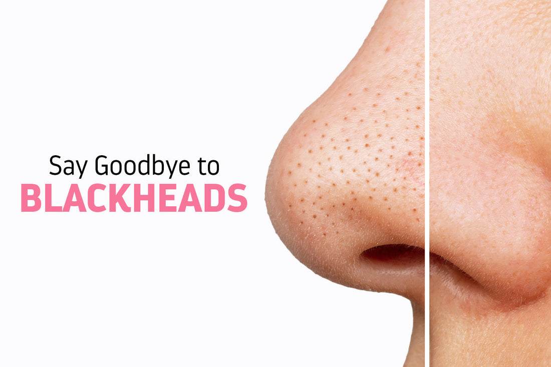 Say Goodbye to Blackheads: The Best Cleansers and Ingredients for Clearer Pores