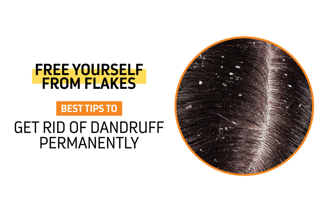 Free Yourself From Flakes: Best Tips to Get Rid of Dandruff Permanently