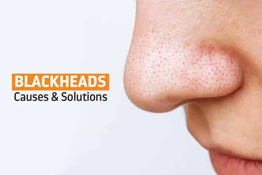 What's Causing Your Blackheads and How to Get Rid of Them