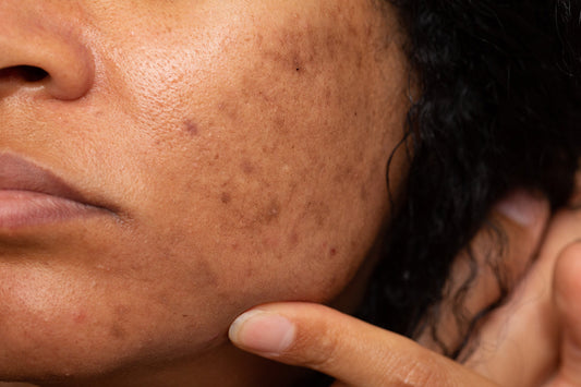 Pigmentation: Treating Acne Marks Before They Set In