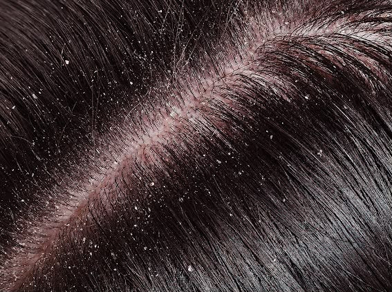 Itchy, Flaky Scalp in Monsoon: Is It Dandruff or a Fungal Infection?