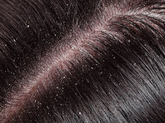 Itchy, Flaky Scalp in Monsoon: Is It Dandruff or a Fungal Infection?