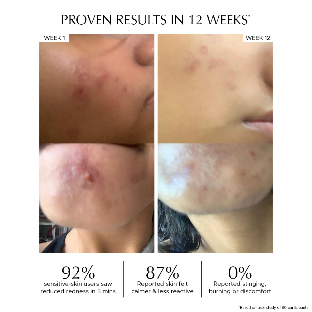 CERA MOIST - 1% iActive Ceramide Calming Moisturizer for Hydration & Skin Barrier Repair