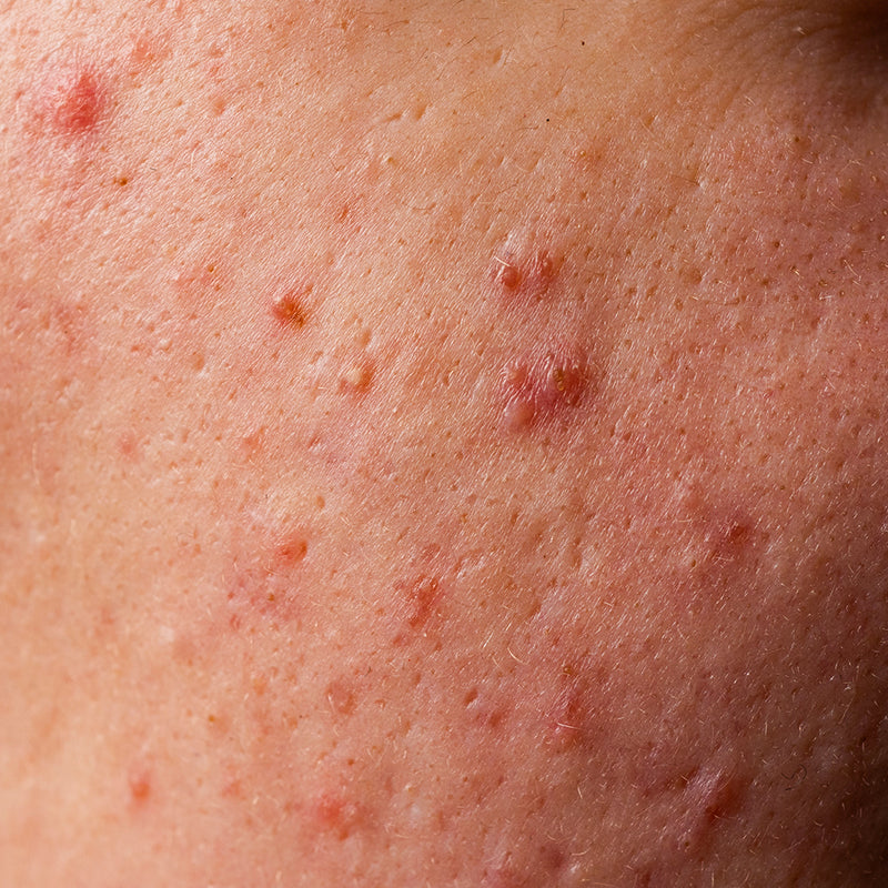 Acne & Enlarged Pores