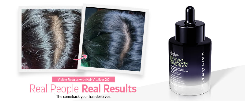 hairfall and Dandruff