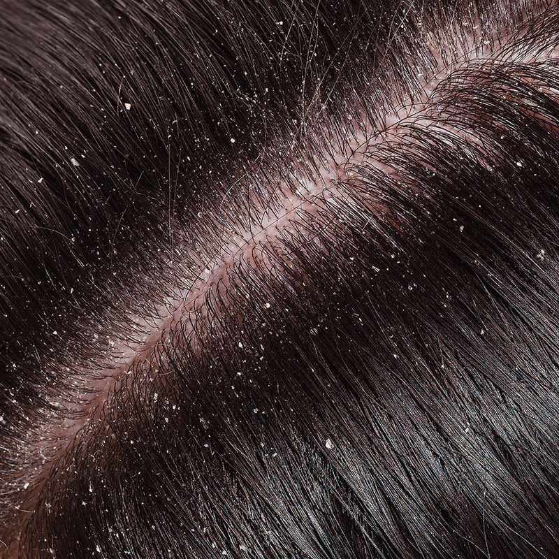 Hairfall & Dandruff