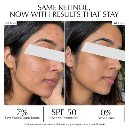 Before and after close-up of a woman’s face showing clearer skin with Vitamin A Pro Retinol and SPF 50 sunscreen gel combo. before after retinol sunscreen results, faded dark spots retinol user study 12 weeks, SPF 50 PA++++ zero white cast sunscreen India, pro-retinol restoring essence dark spot fading. pigmentation