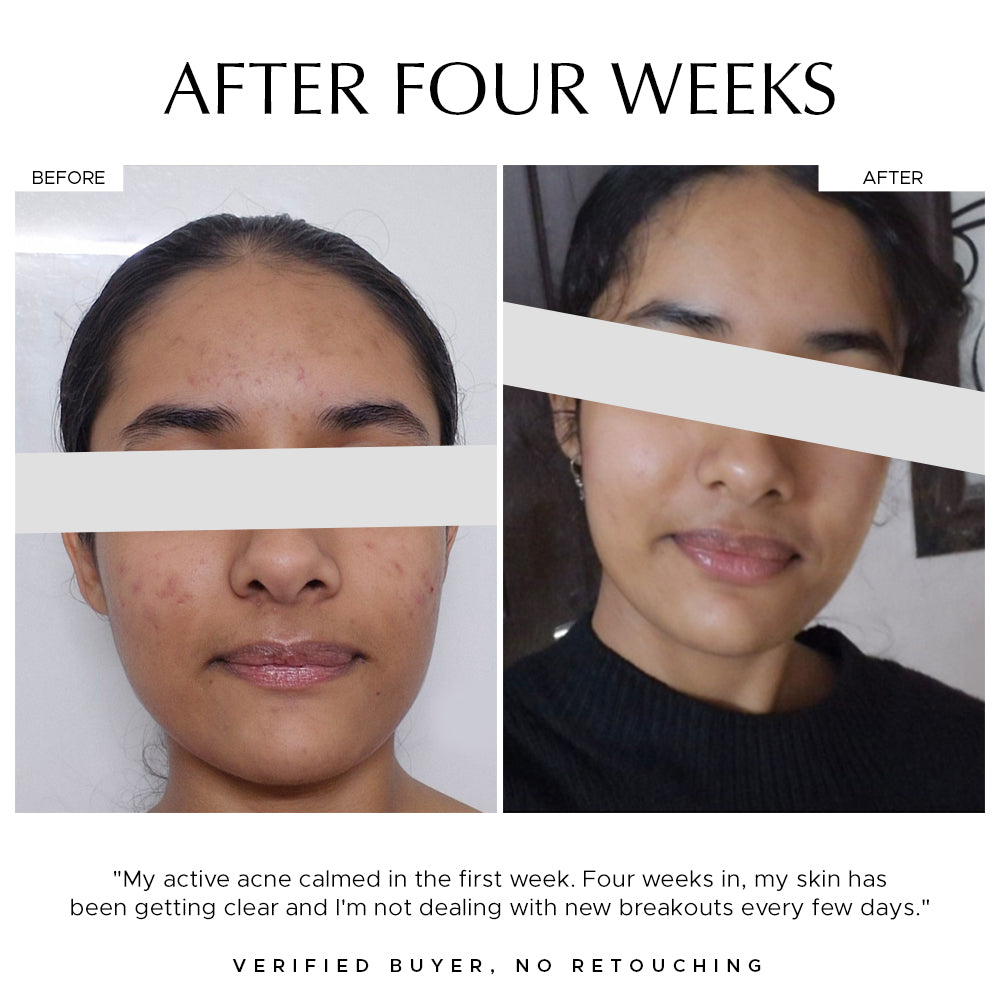 Heads Off - Anti Acne Serum For Blackheads & Whiteheads
