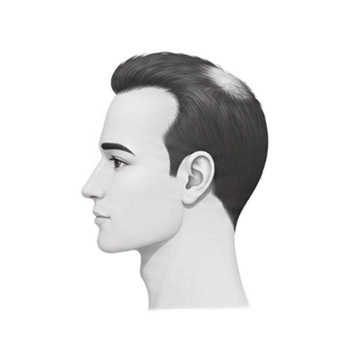 Stage 3 — M-shaped hairline