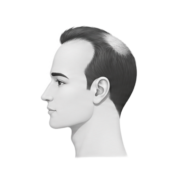 Stage 4 — crown thinning