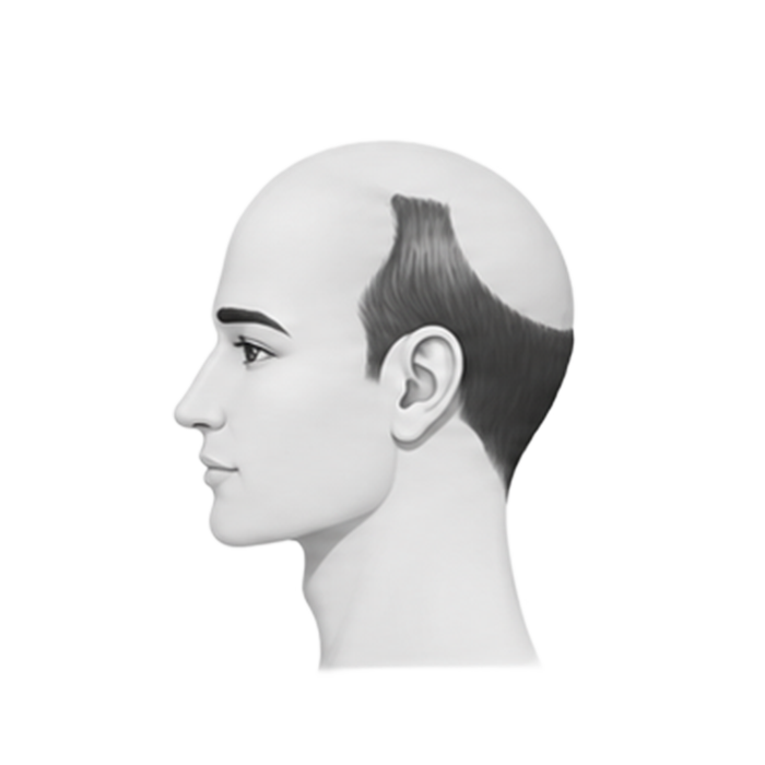 Stage 6 — crown bald