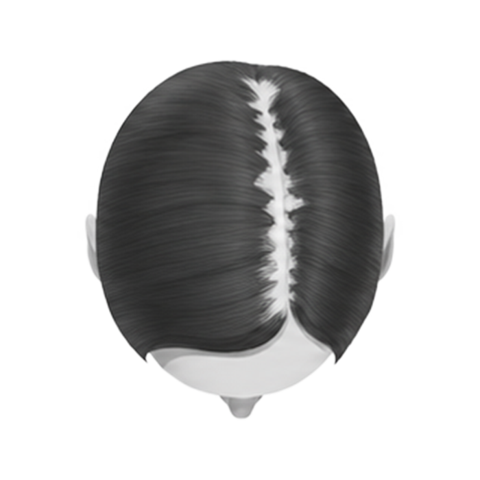 Stage 2 — wider parting