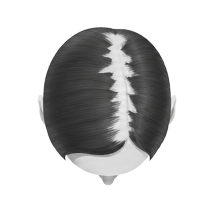 Stage 3 — visible scalp